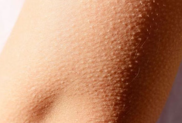 طرق طبيعية للتخلص من جلد الوزة