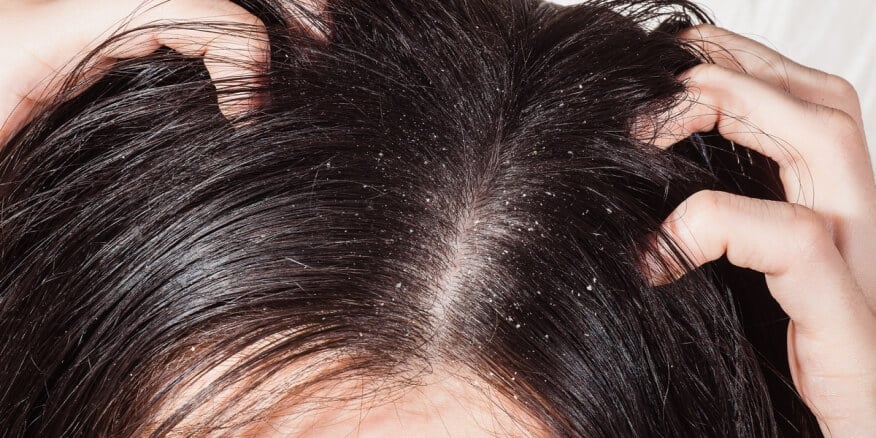 التخلص من قشرة الشعر