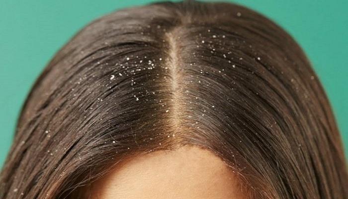 وصفات طبيعية للتخلص من  قشرة الشعر