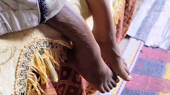 الشلل-النصفى-للطفل