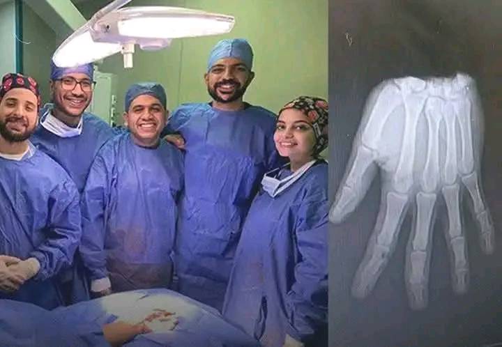  فريق طبى بقصر العينى يعيد زراعة يد مبتوره بالكامل لمريض عمره 20 عاما (2)