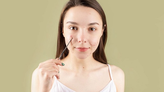 بثور البشرة