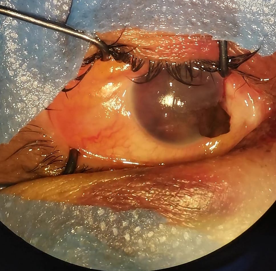 إجراء عملية جراحية لعين نصابة 