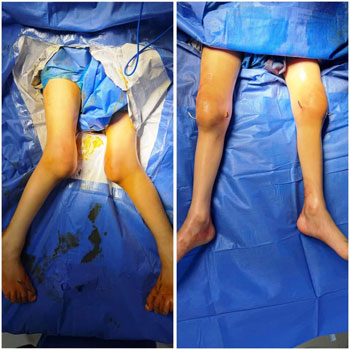 الطفل-قبل-وبعد-إجراء-العملية الطفل-قبل-وبعد-إجراء-العملية