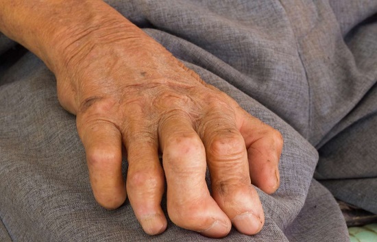 مرض الجذام مرض الجذام