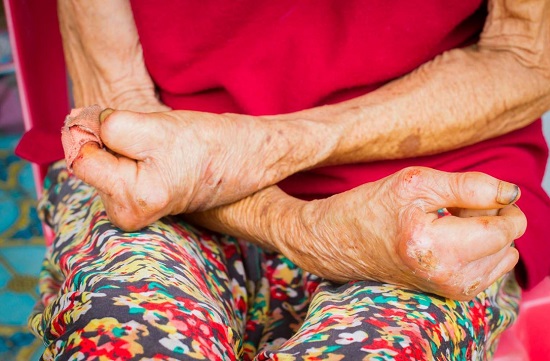 مريض الجذام مريض الجذام