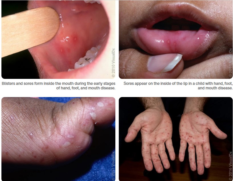 فوس اليد والفم والقدمين