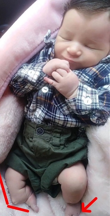 براء بعد الولادة