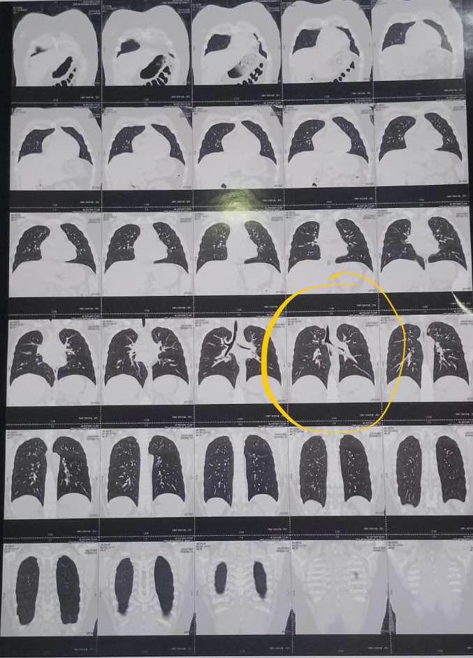 ظهور لبيسة القلم في الأشعة المقطعية