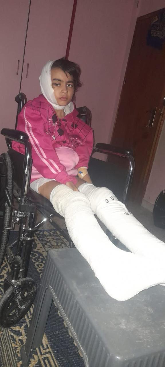 الطفلة ديما أبو شكيان بعد إصابتها الطفلة ديما أبو شكيان بعد إصابتها