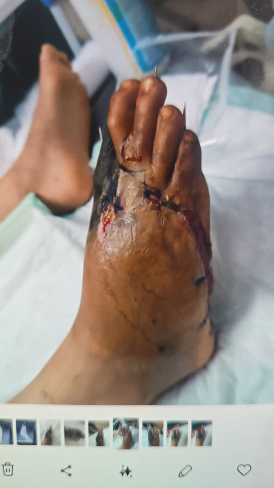 إصابة آدم ياغي