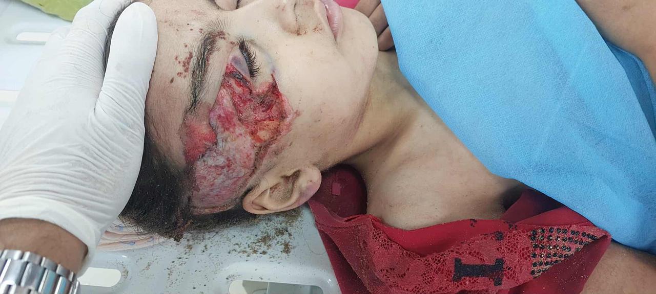 ديما أبو شكيان بعد إصابتها خلال الحرب ديما أبو شكيان بعد إصابتها خلال الحرب