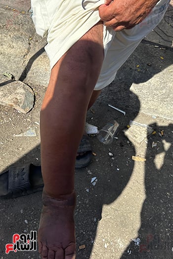 مرض-بقدمه مرض-بقدمه