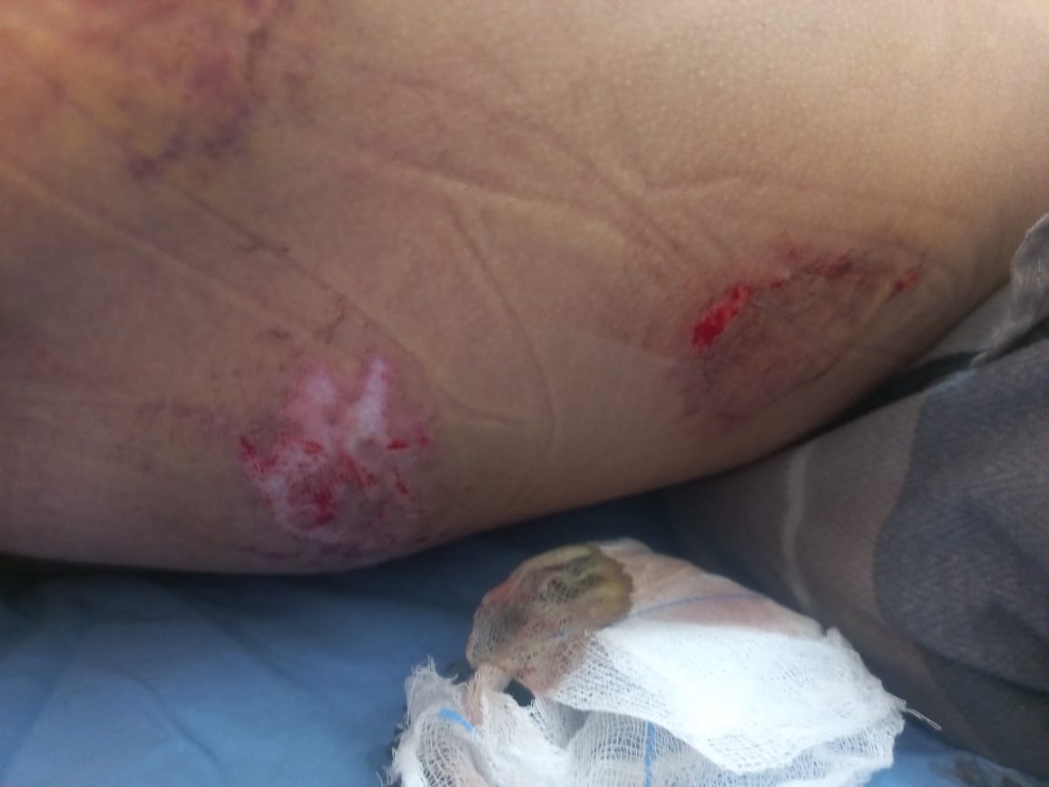 تفاصيل إصابة الطفل محمد أبو حلس تفاصيل إصابة الطفل محمد أبو حلس