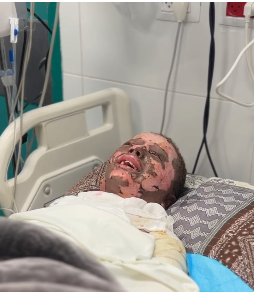 الطفل مجد أبو حبيب بعد الحرب