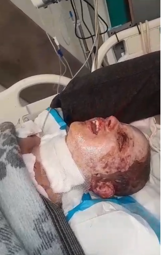 الطفل مجد أبو حبيب داخل المستشفى