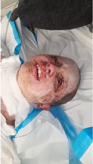 الطفل مجد أبو حبيب يصرخ بسبب الحروق