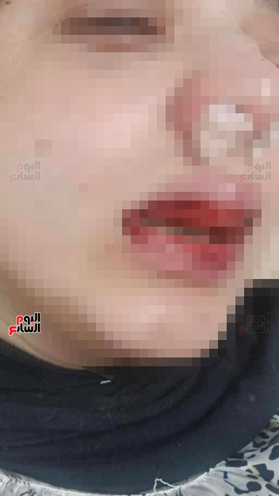 اصتبات-الوجه