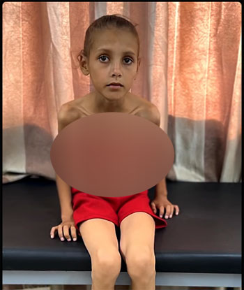 438569-الطفلة-بيان-صقر-بعد-الإصابة 438569-الطفلة-بيان-صقر-بعد-الإصابة