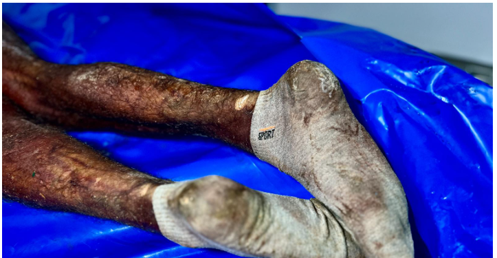 آثار تعذيب الأسرى الفلسطينيين