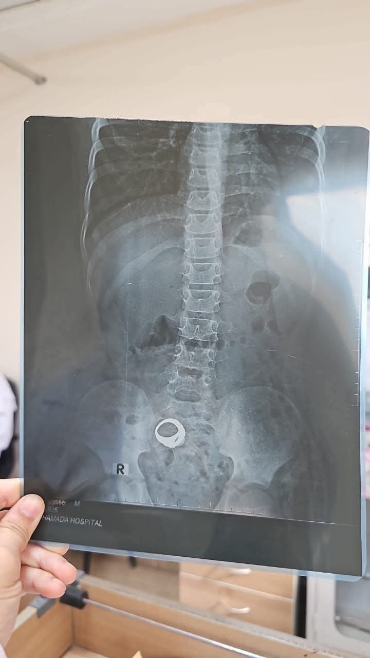 الخاتم المعندى يظهر فى الأشعة