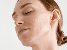 حفر حب الشباب حفر حب الشباب