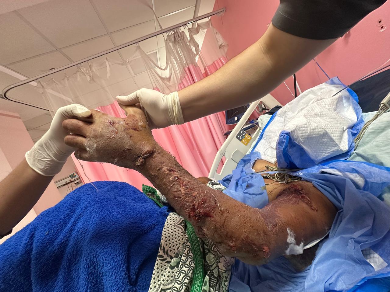 إنقاذ حالتين من بتر مؤكد إنقاذ حالتين من بتر مؤكد