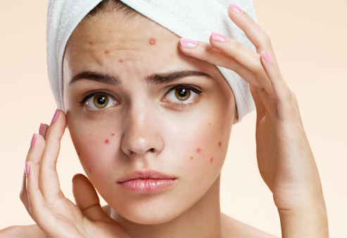 حب الشباب حب الشباب