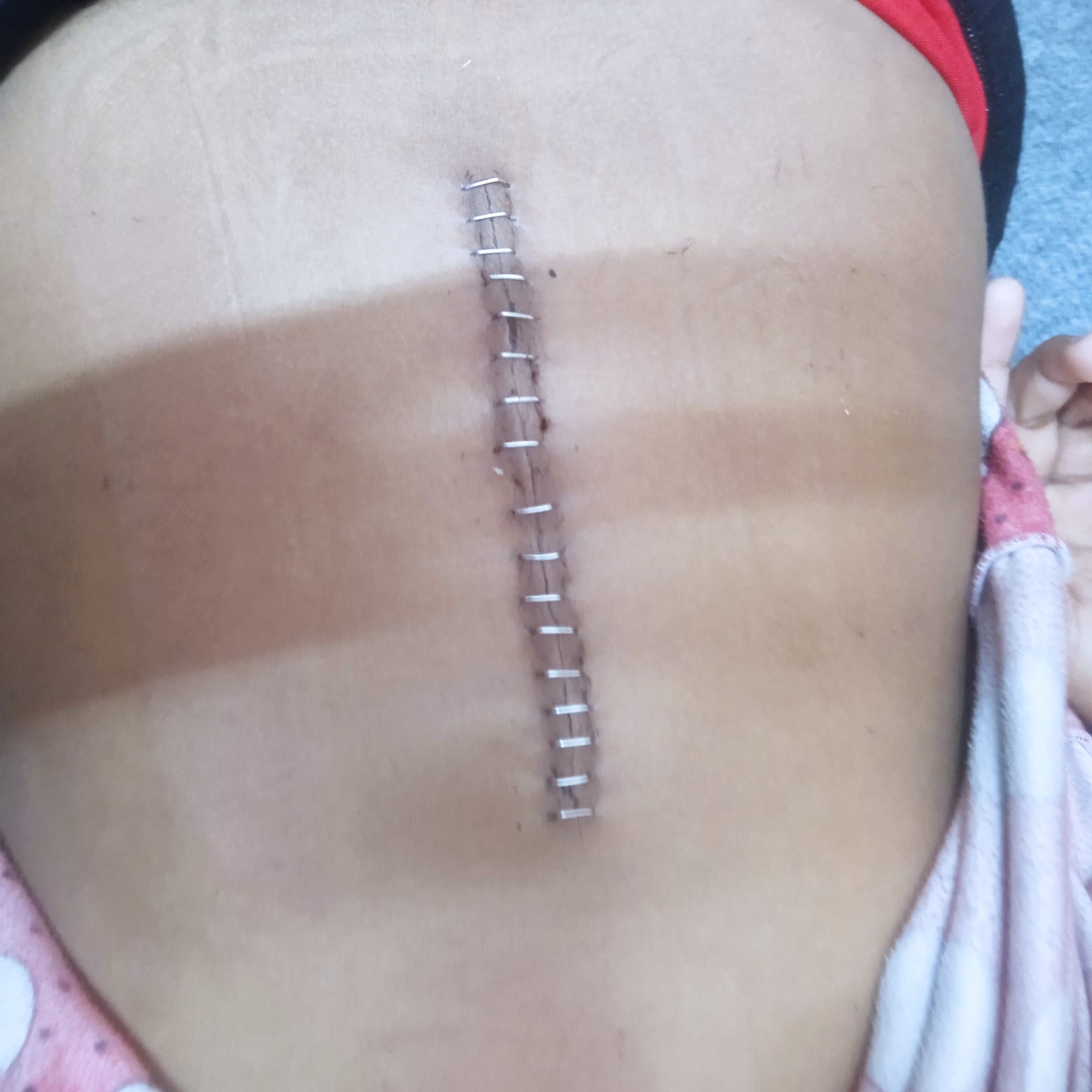 إصابة الطفلة بتول مطر إصابة الطفلة بتول مطر