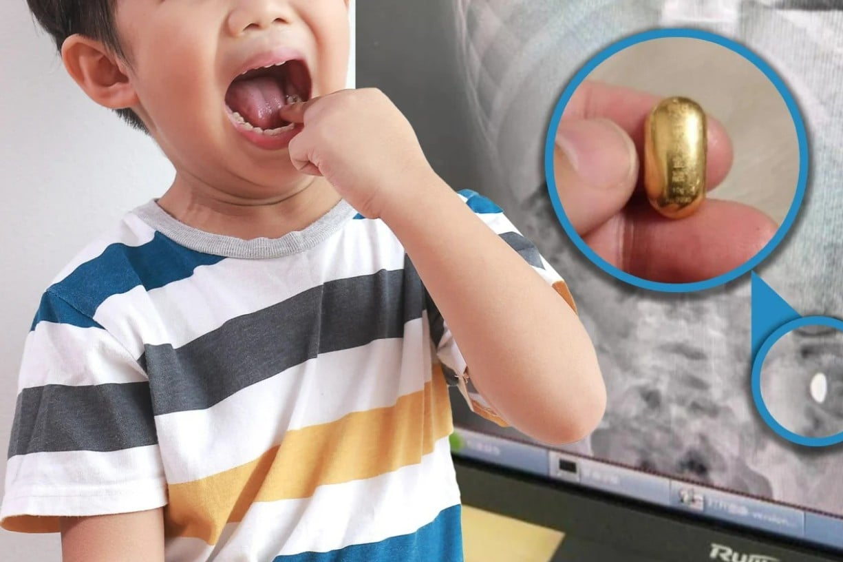 طفل يبتلع قطعة ذهبية أثناء تدريبات تقوية اللسان