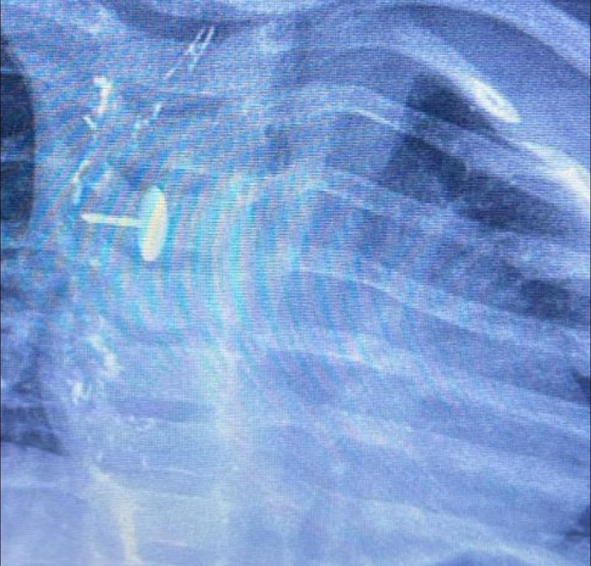 فريق جراحى بالقليوبية يستخرج دبوس ضغط من مرئ طفلة (1)