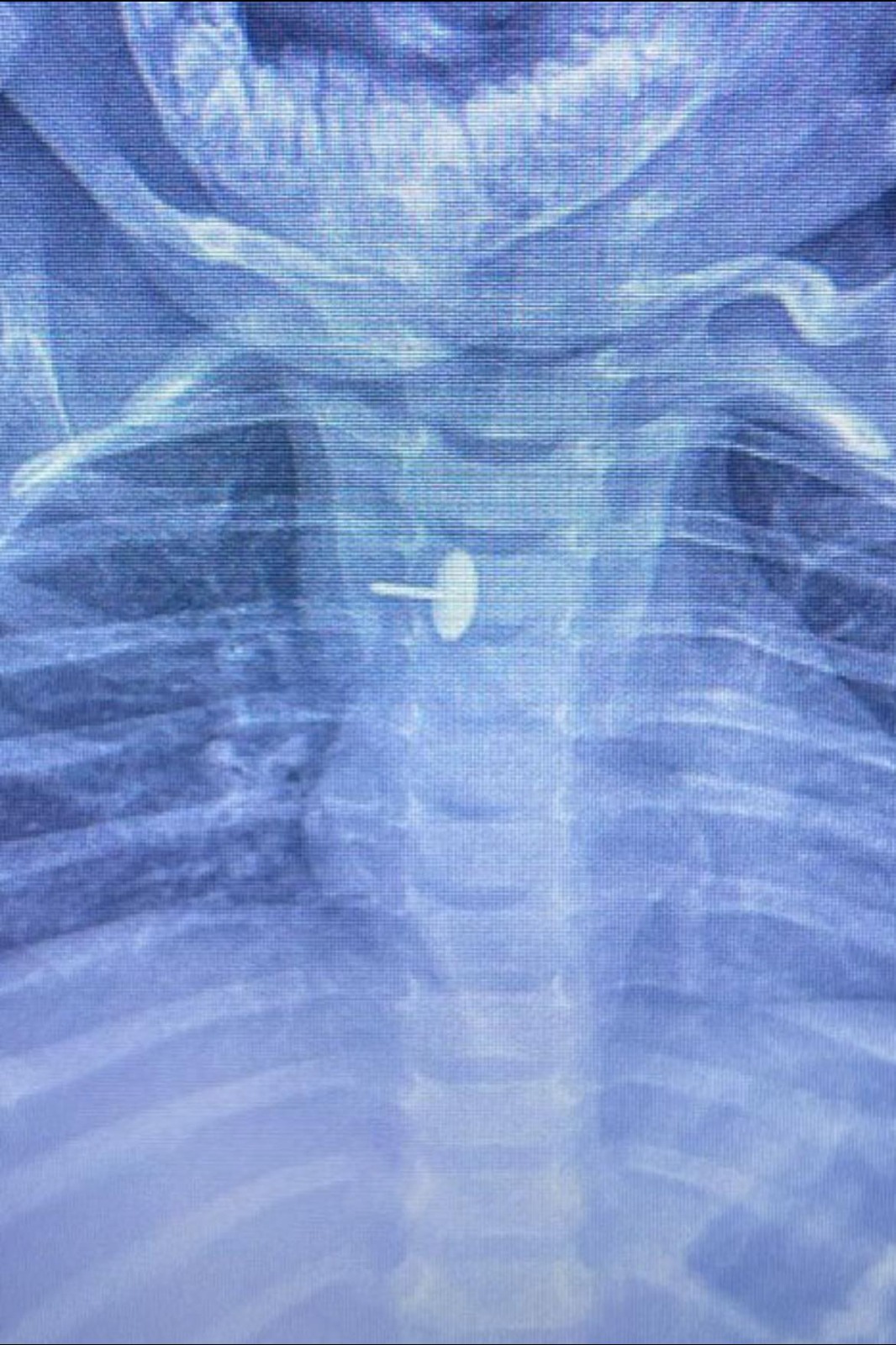 فريق جراحى بالقليوبية يستخرج دبوس ضغط من مرئ طفلة (4)