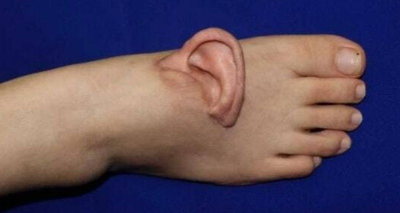 زراعة أذن فى القدم بسبب حادث زراعة أذن فى القدم بسبب حادث