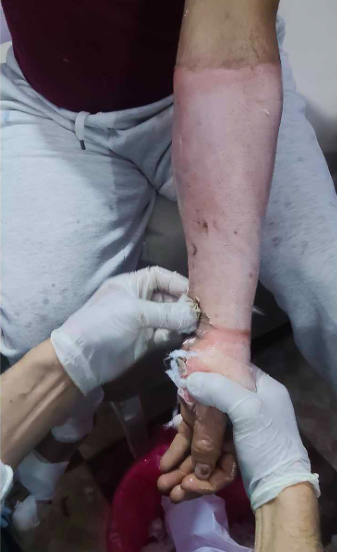 جانب من الحروق التي أصابت زغلول فرج الله 