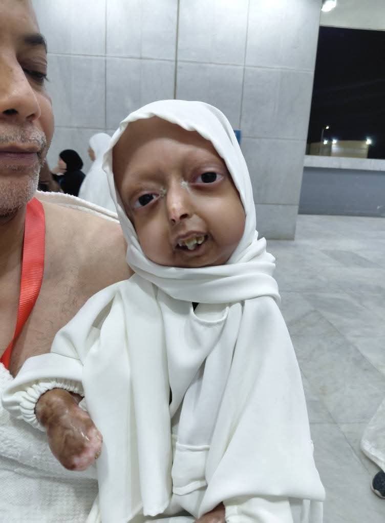 وفاة آلاء فتاة الشيخوخة بقنا