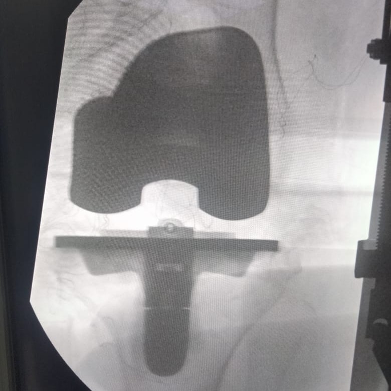 مفصل الركبة