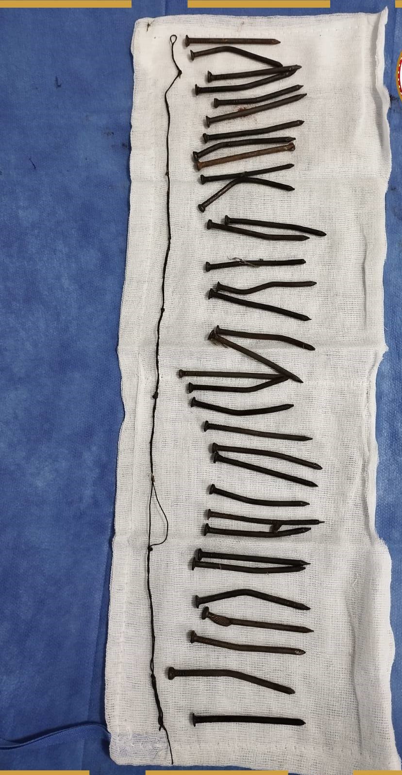 المسامير المستخرجة من معدة مريضة