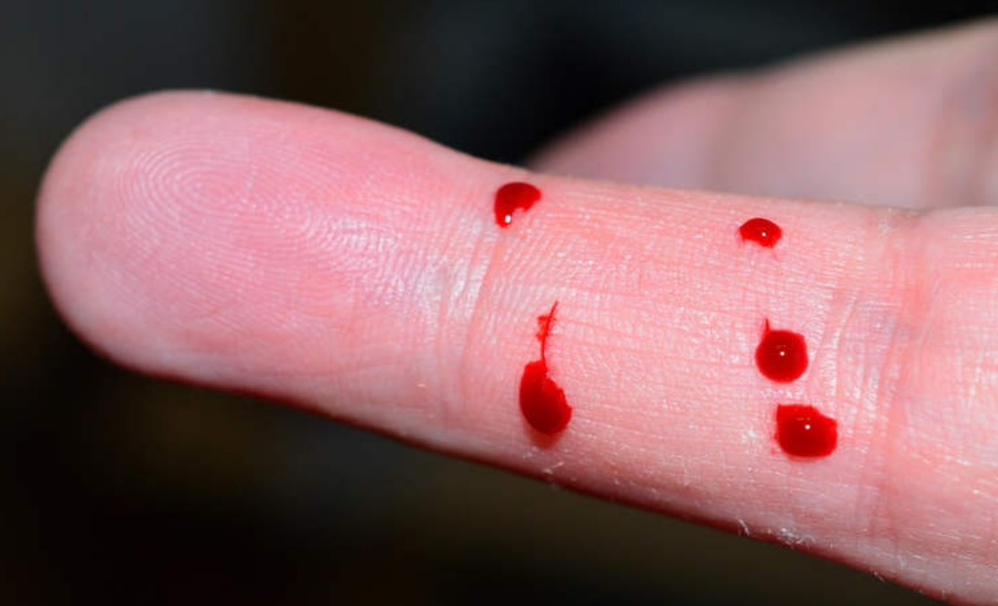 مراهق يُصاب بالتسمم بعد شرب دمه لزيادة مستويات الحديد في دمه مراهق يُصاب بالتسمم بعد شرب دمه لزيادة مستويات الحديد في دمه