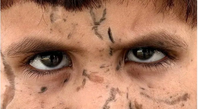 آدم أبو حليب.. طفل فلسطينى قصف منزله.. فقد شقيقه ويواجه خطر فقدان عينيه