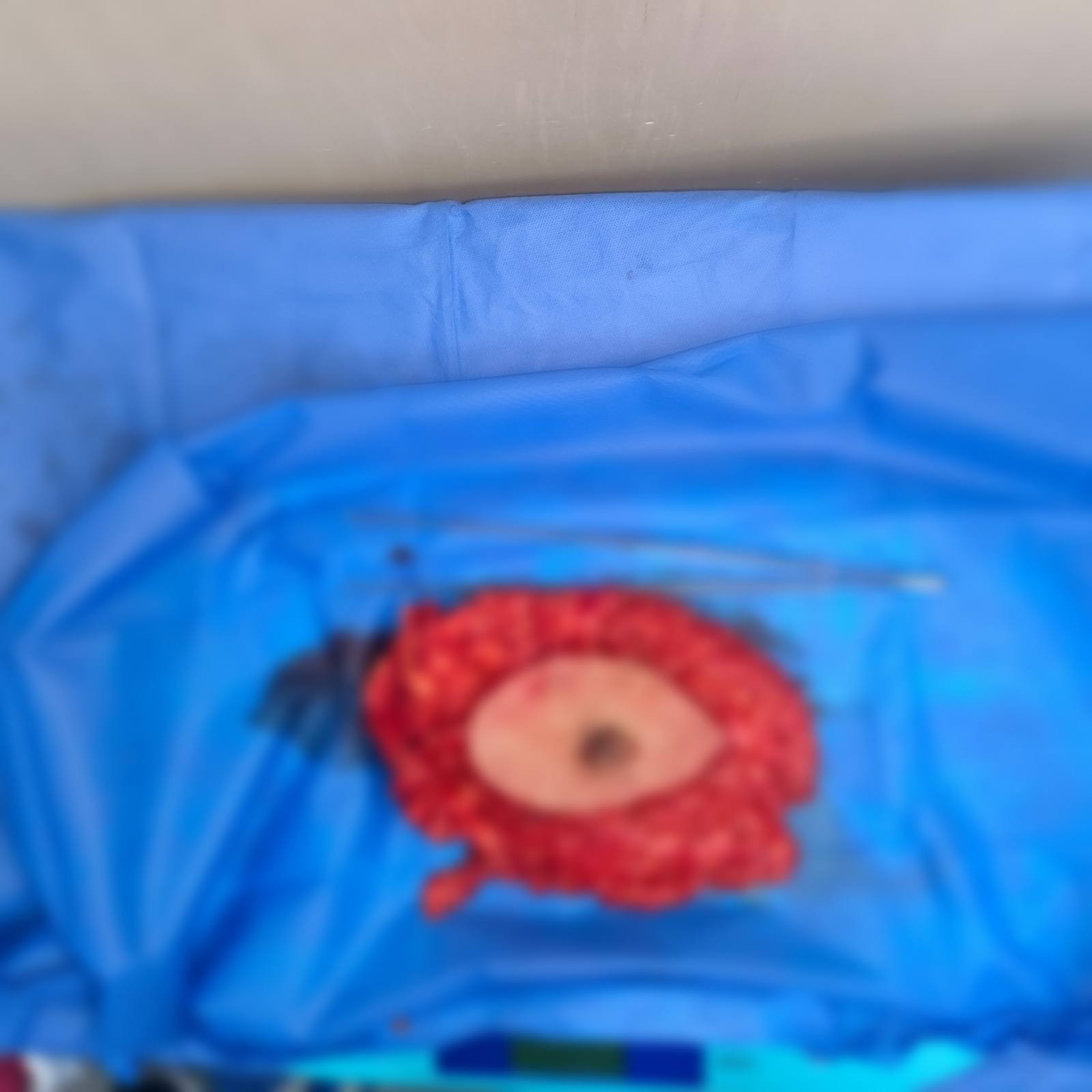 نجاح أول عملية لتقشير أورام الجهاز الهضمي (1)