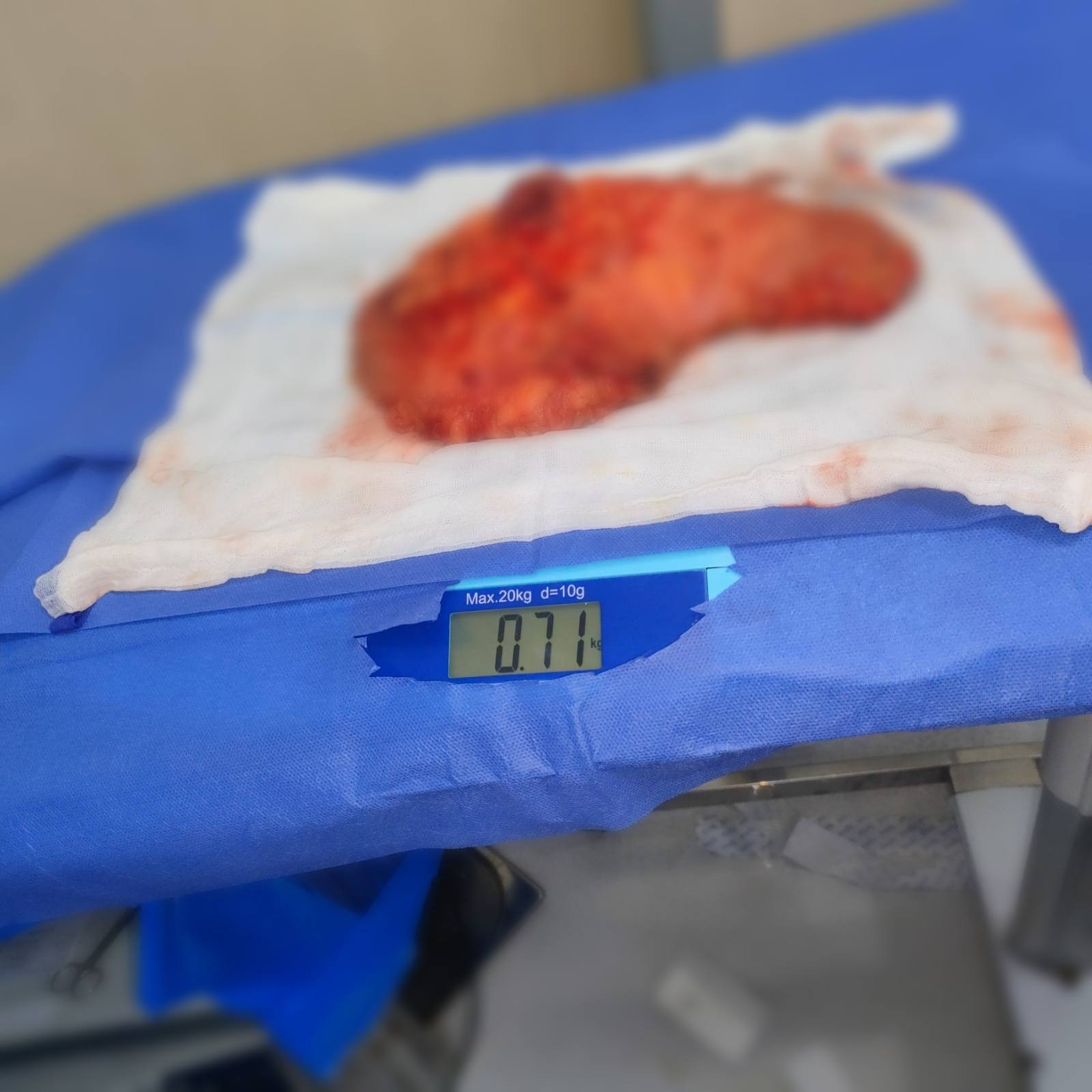 نجاح أول عملية لتقشير أورام الجهاز الهضمي (2)