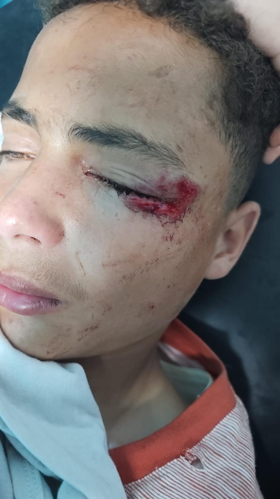جرحى عالجهم هيرون فرناندو في غزة
