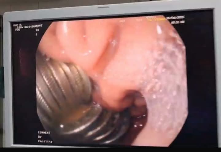 استخراج 13 جنيهًا معدنيًا من معدة طفل استخراج 13 جنيهًا معدنيًا من معدة طفل