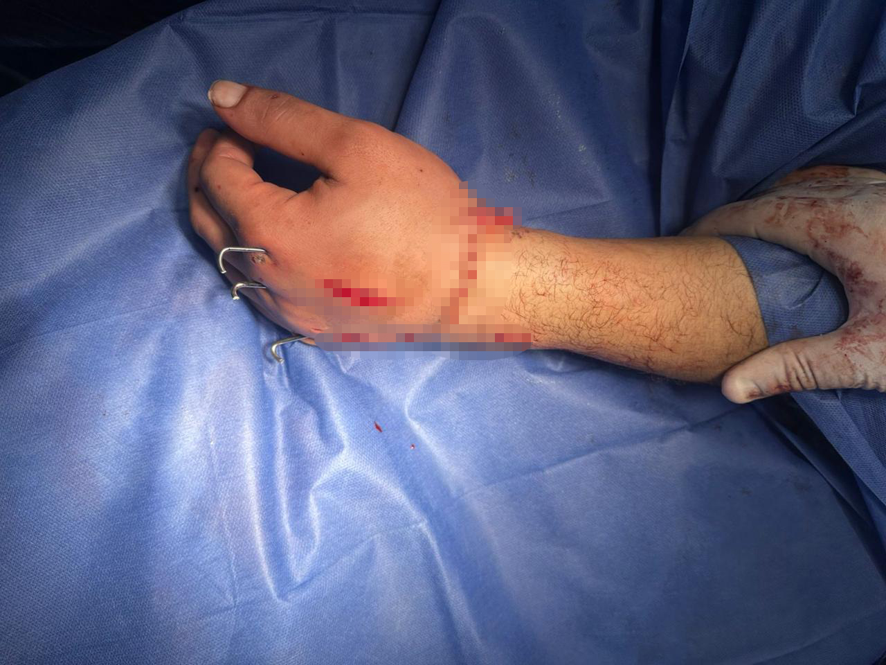 نجاح جراحة زراعة يد مبتورة لمريض في مستشفى الطوارئ بقصر العيني نجاح جراحة زراعة يد مبتورة لمريض في مستشفى الطوارئ بقصر العيني