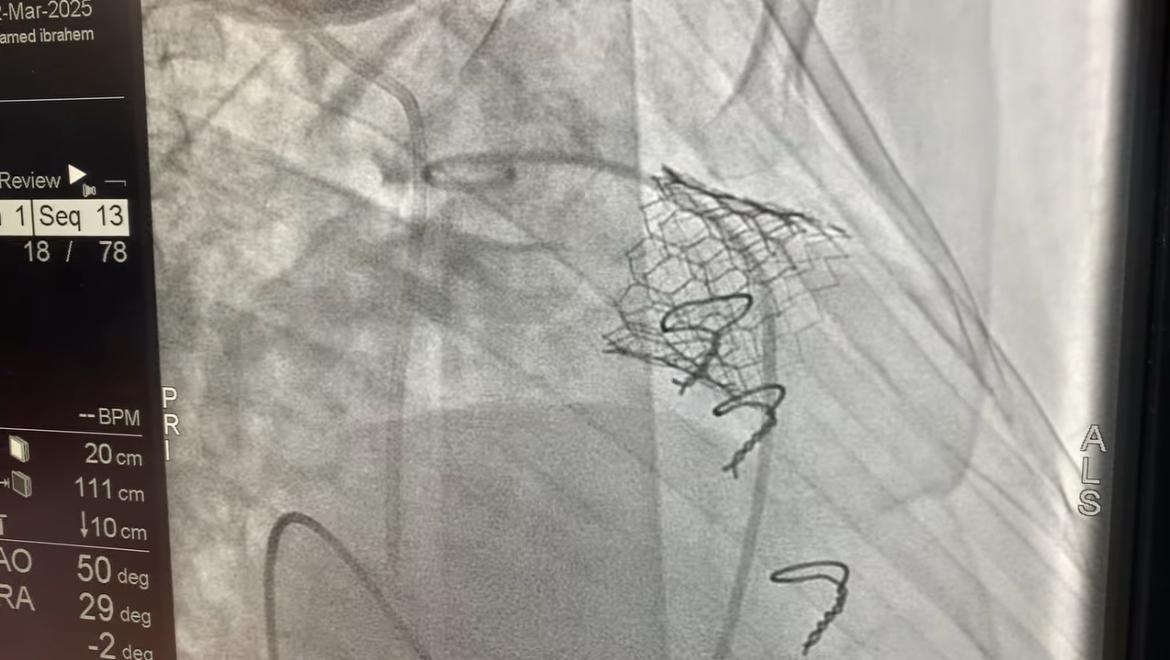 معهد القلب ينجح فى إجراء 4 عمليات زراعة صمام رئوي باستخدام تقنية MYVAL (4)