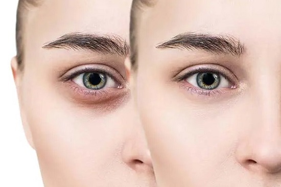 طرق طبيعية للتخلص من الهالات السوداء طرق طبيعية للتخلص من الهالات السوداء