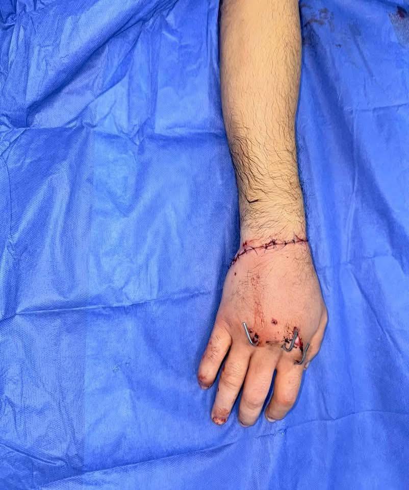 أطباء طب الأزهر يعيدون يد شاب بعد بترها بالكامل أطباء طب الأزهر يعيدون يد شاب بعد بترها بالكامل