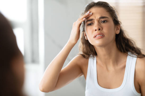 حيل للتخلص من حبوب الجبهة حيل للتخلص من حبوب الجبهة