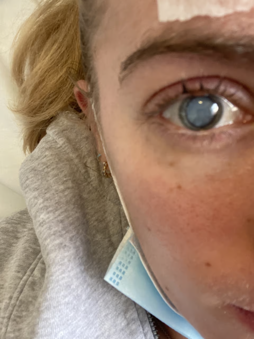 العدوى النادرة بالعين