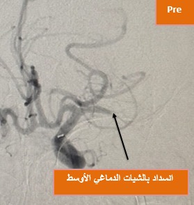 تدخل جراحى دقيق